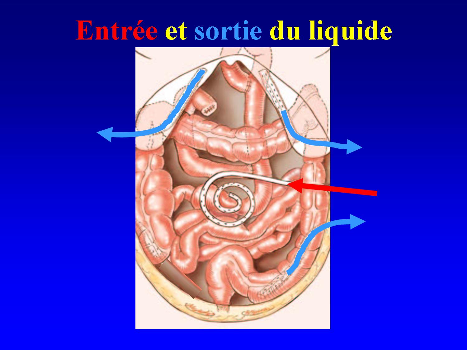 CHIP HIPEC OVHIPEC cancer du péritoine cancer péritonéal métastases péritonéales chimiothérapie
